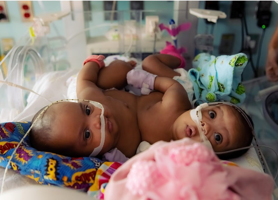 Family of formerly conjoined twins say they’re ‘doing great’ 1 year after surgery